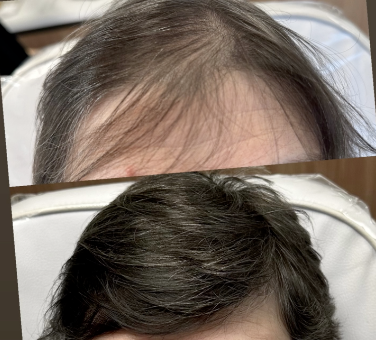 Resultado de paciente — alopecia androgenética · linha frontal